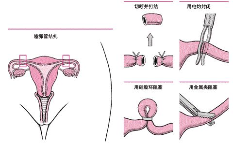 女性避孕新选择，现代节育技术的革新与探索